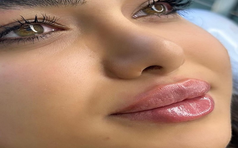 انواع تزریق ژل لب، مزایا، عوارض و انتخاب بهترین مدل 6 مدل قلوهای (Plump Lips)