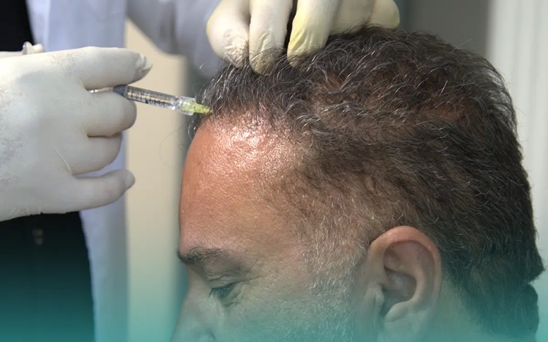 روش های جایگزین کاشت مو: معرفی کامل و مزایا و معایب 1 مزوتراپی مو: تقویت و تحریک فولیکولها