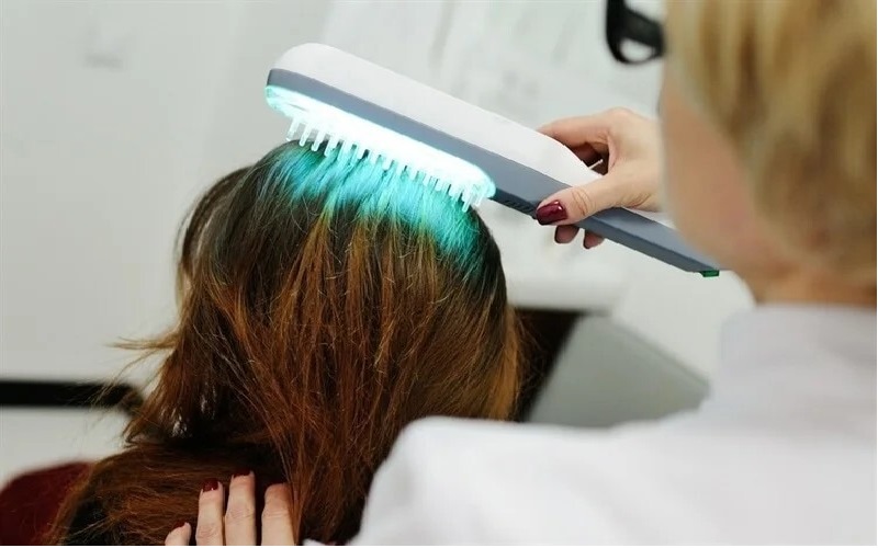 روش های جایگزین کاشت مو: معرفی کامل و مزایا و معایب 3 نوردرمانی با لیزر سطح پایین (LLLT)