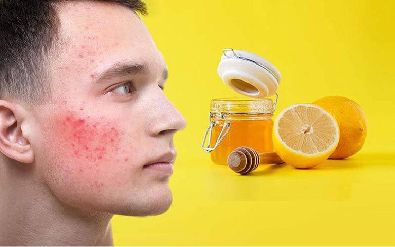 ۵ روش معجزهآسا: درمان خانگی لک صورت و داشتن پوستی شفاف 5 ماسک لیمو و عسل: ترکیب طلایی