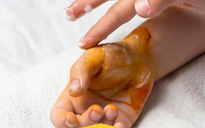 از بین بردن جای سوختگی در خانه: روشهای خانگی مؤثر و سریع 1 عسل درمانی: ترمیمکننده و ضدعفونیکننده طبیعی