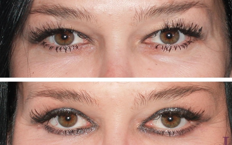 تفاوت عمل چشم گربه ای و چشم روباهی: راهنمای جامع انتخاب 1 عمل چشم گربهای