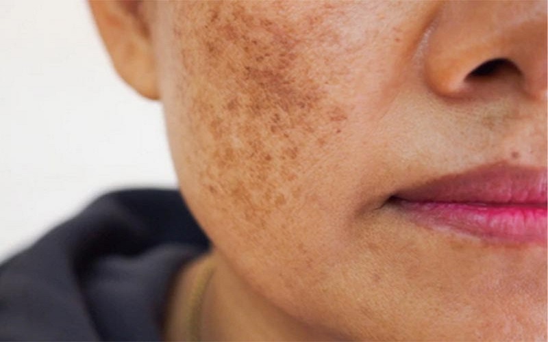 آشنایی کامل با انواع لک صورت، علل و بهترین راههای درمان و پیشگیری 3 هایپرپیگمانتاسیون پس از التهاب (PIH): یادگار جوش و زخم