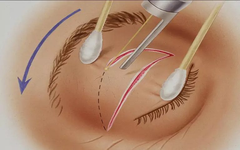 جراحی زیبایی پلک