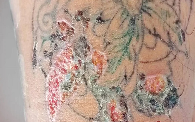 عوارض تتو چیست؟ ۱۱ خطری که پیش از خالکوبی باید بدانید! 3 تأثیر تتو بر عملکرد تعریق بدن