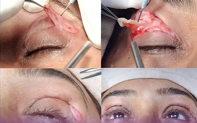 انواع جراحی زیبایی پلک: راهنمای کامل برای انتخابی آگاهانه و نتایج طبیعی 1 جراحی زیبایی پلک چیست و چرا انجام میشود؟