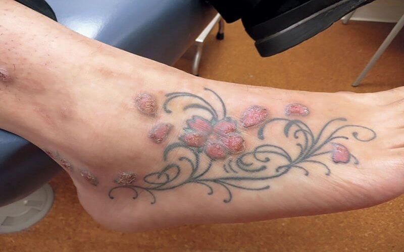 عوارض تتو چیست؟ ۱۱ خطری که پیش از خالکوبی باید بدانید! 4 چگونه از عوارض و خطرات تتو پیشگیری کنیم؟