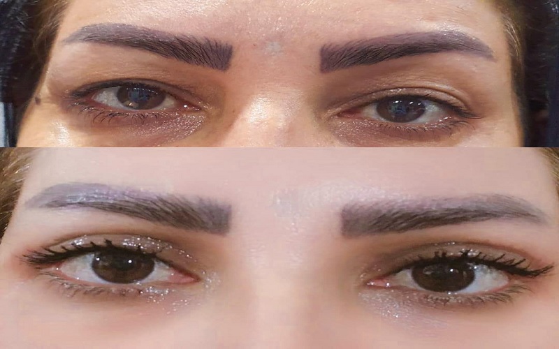 انواع جراحی زیبایی پلک: راهنمای کامل برای انتخابی آگاهانه و نتایج طبیعی 2 سایر جراحیهای مکمل و تخصصی پلک