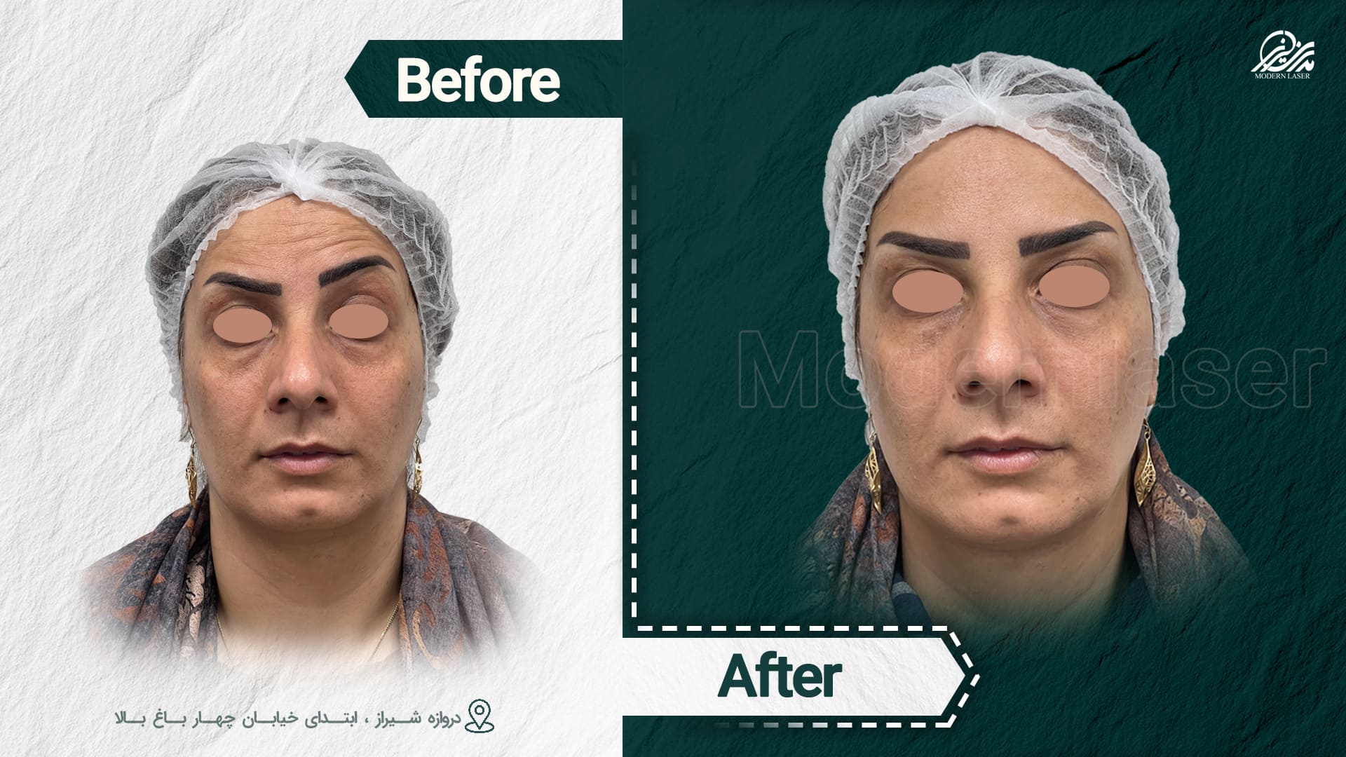 تزریق ژل و بوتاکس 6 +1007