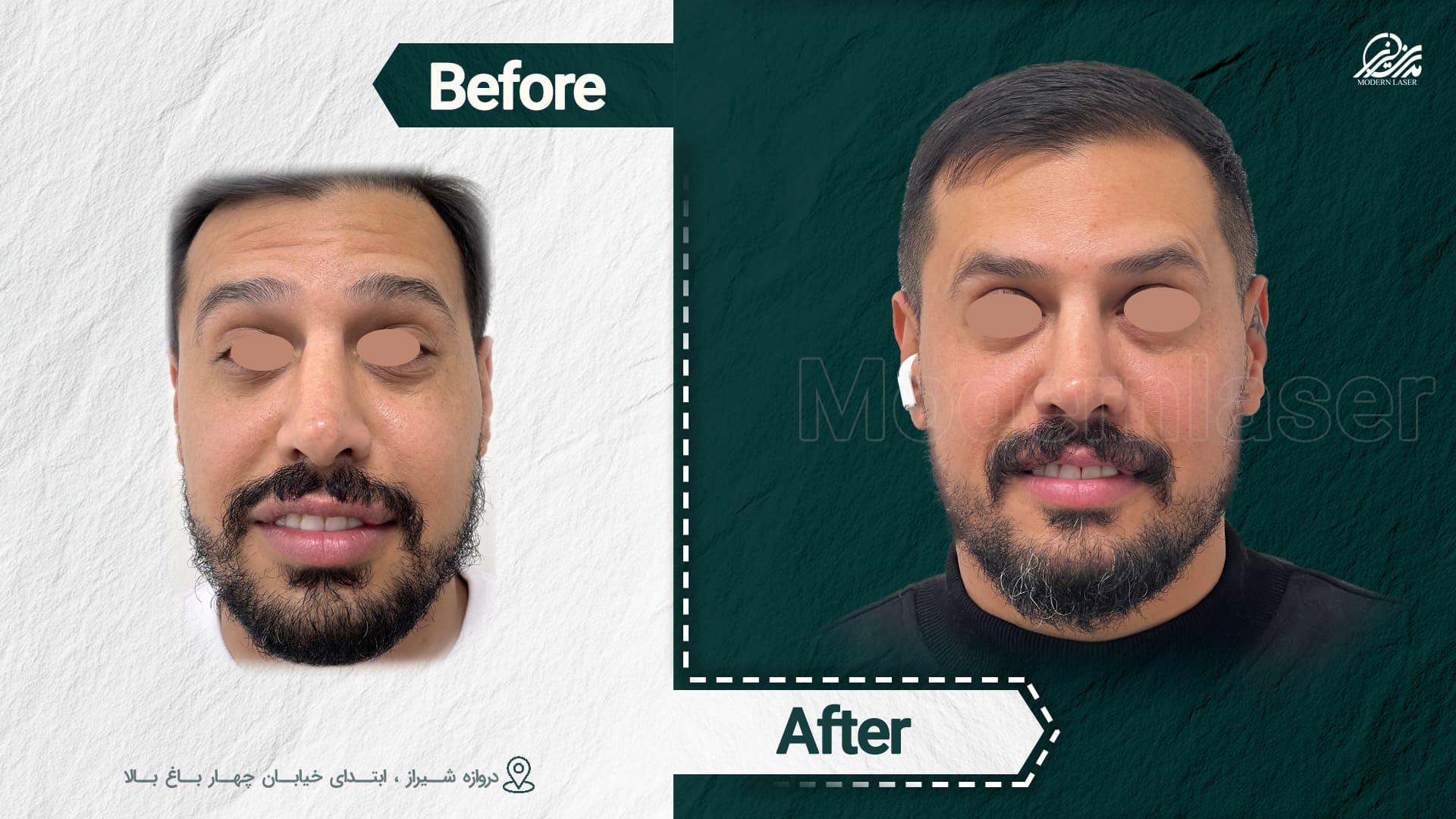 تزریق ژل و بوتاکس 7 1009