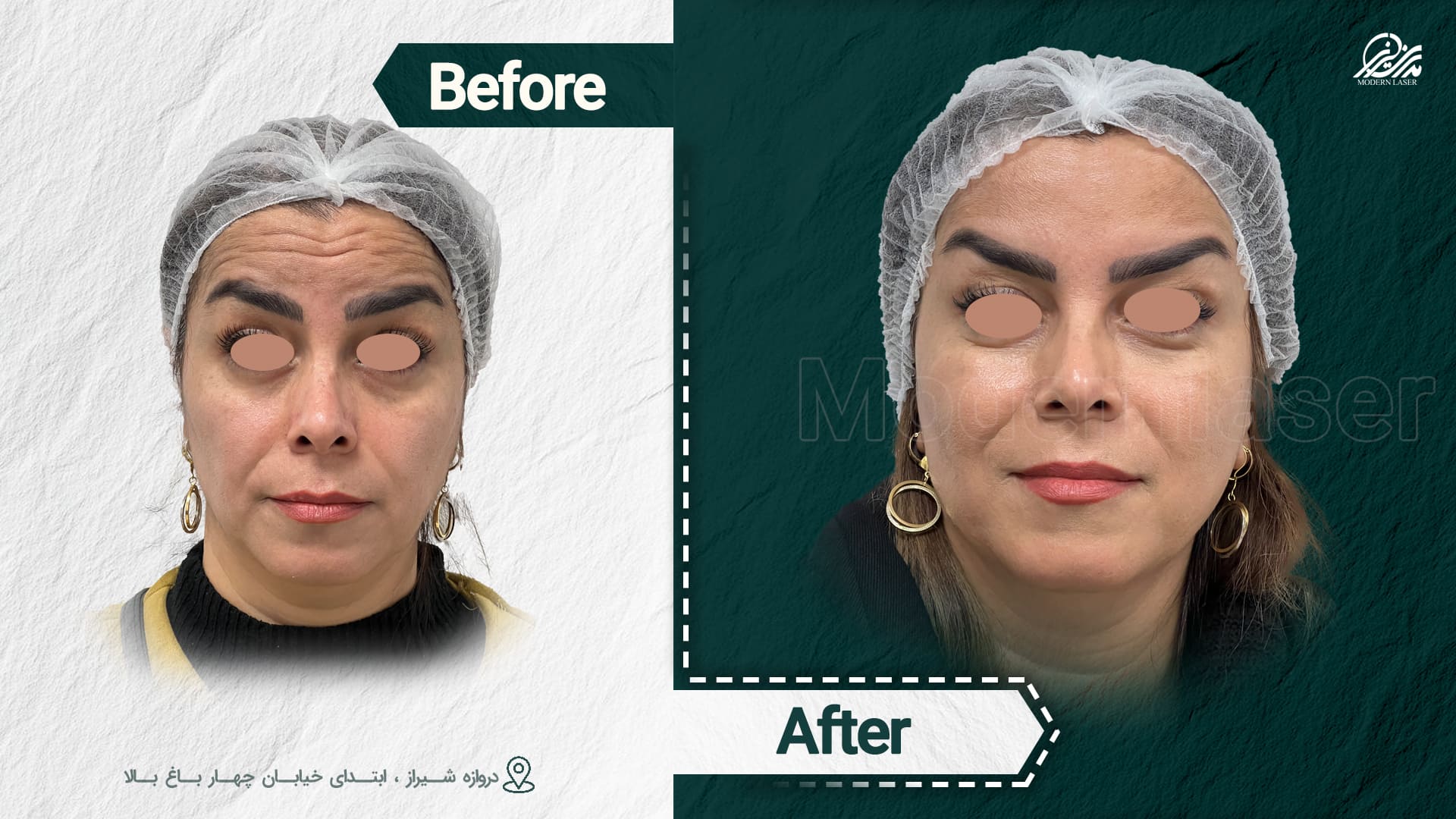 تزریق ژل و بوتاکس 8 1012