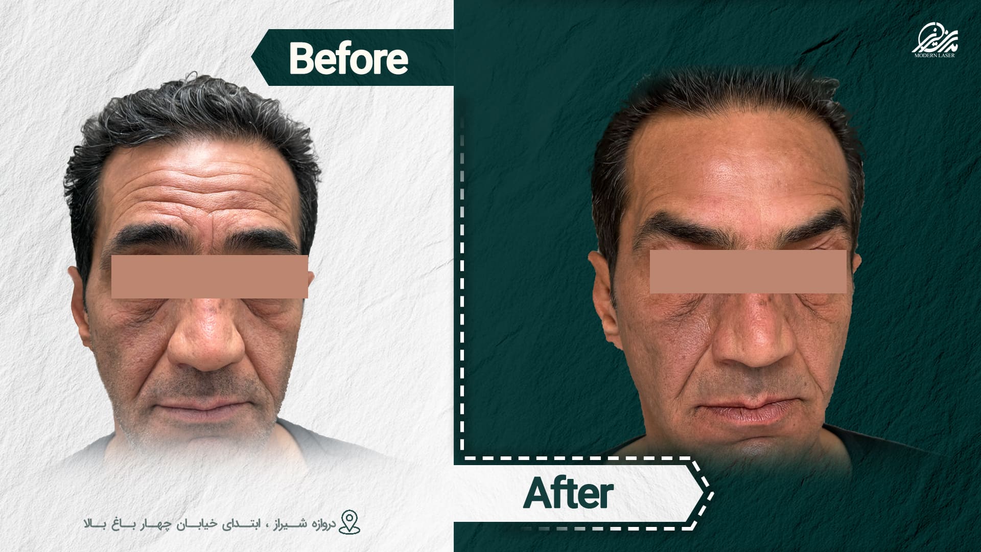 تزریق ژل و بوتاکس 9 1016