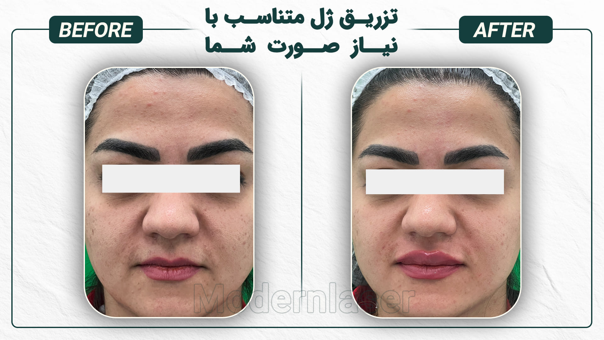 تزریق فیلر و ژل در اصفهان 13 انواع ژل لب