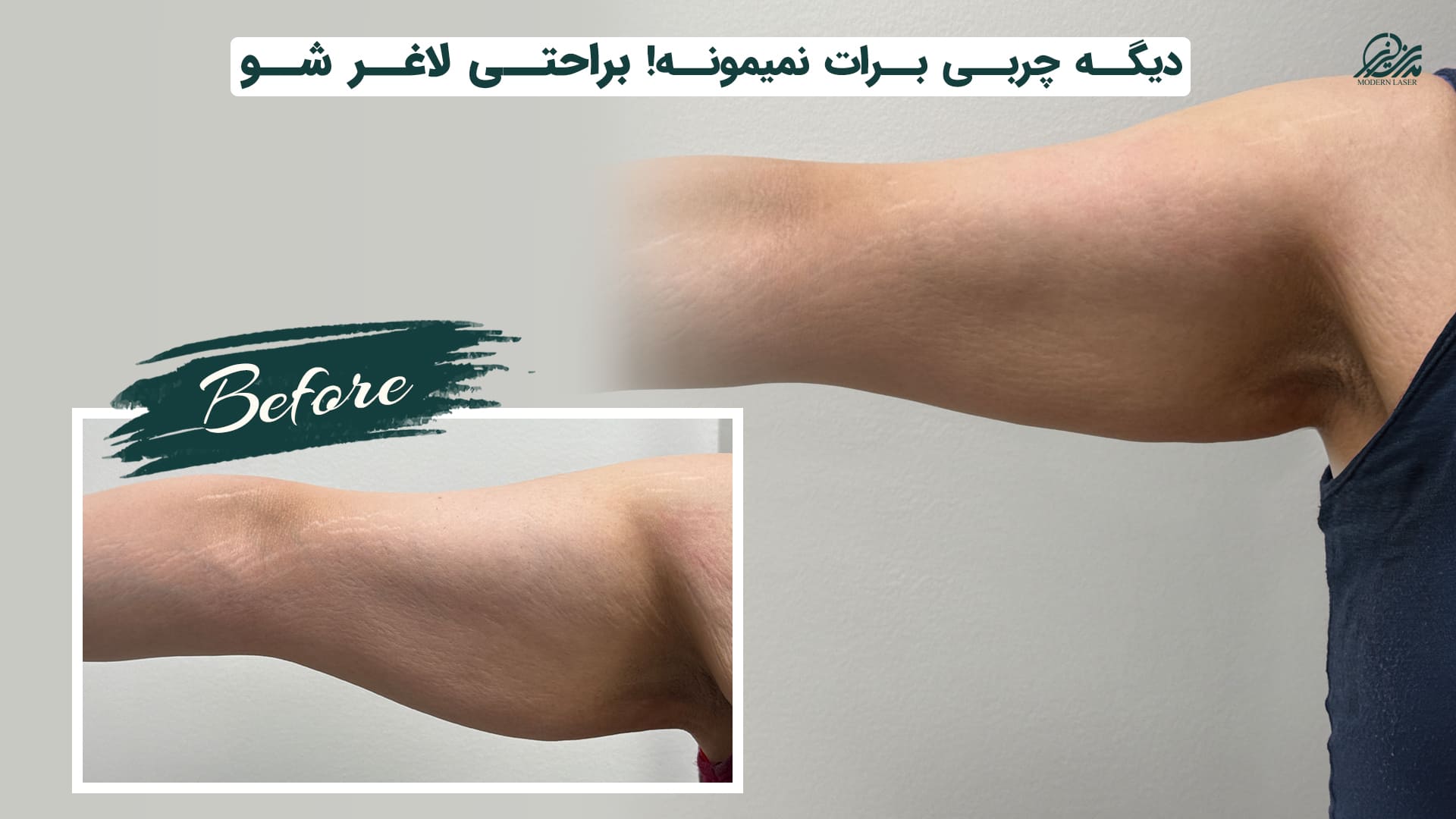 لاغری در اصفهان 11 لاغری موضعی در اصفهان