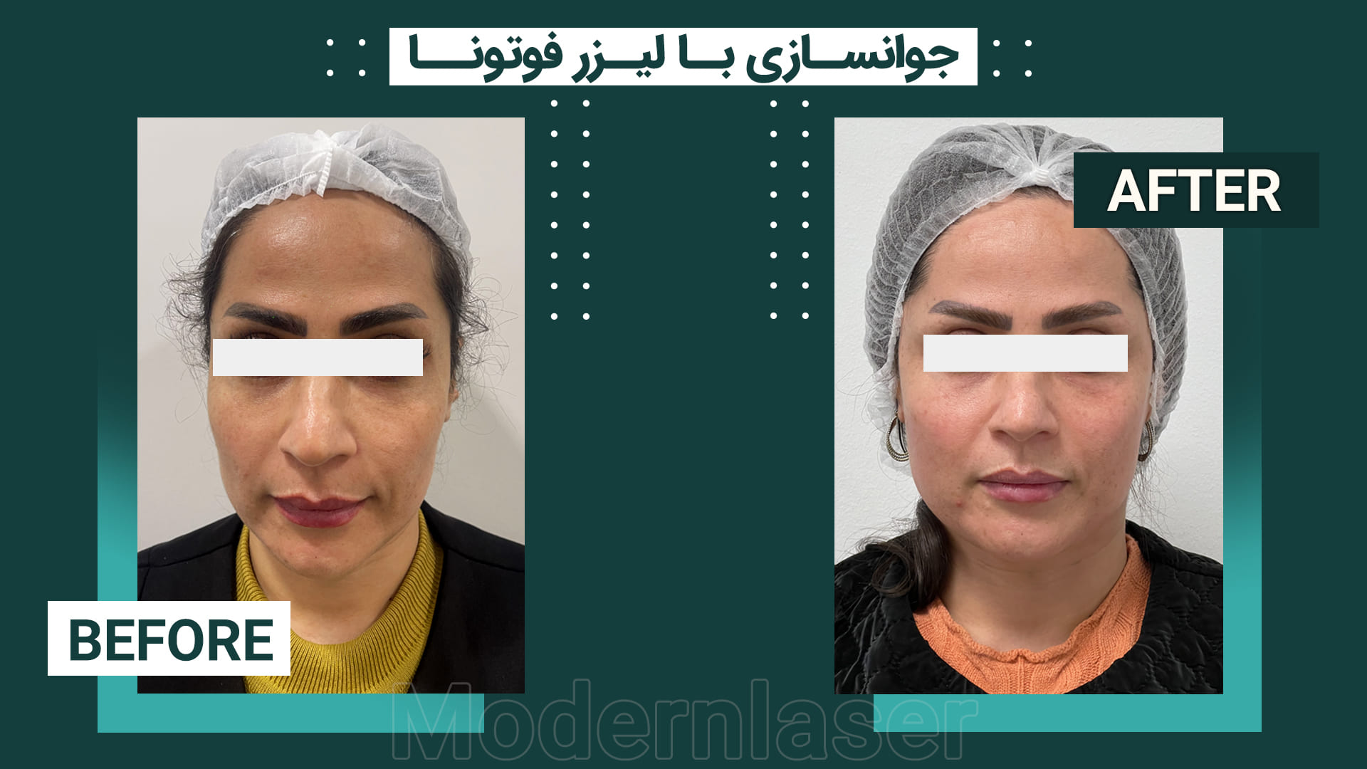 جوانسازی پوست در اصفهان 9 4 1