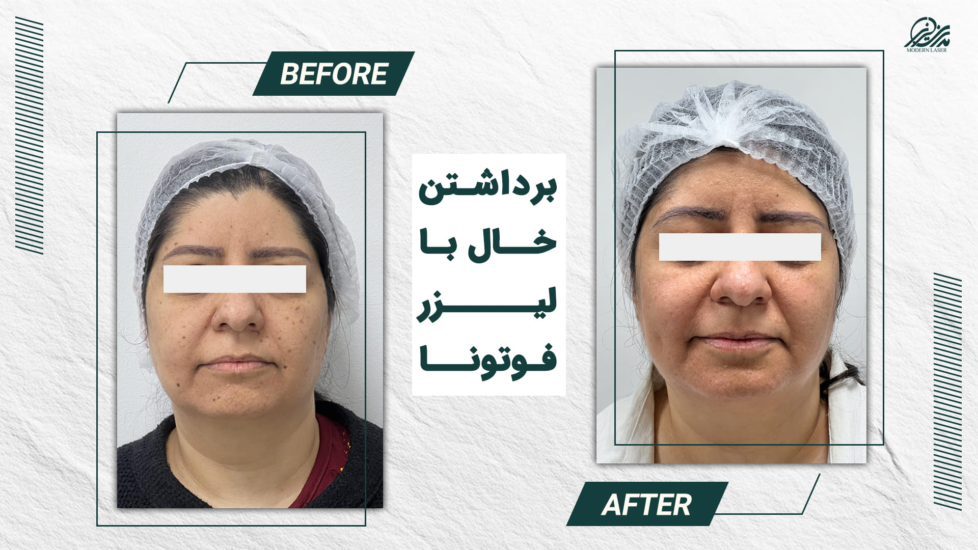 برداشتن خال 3 4