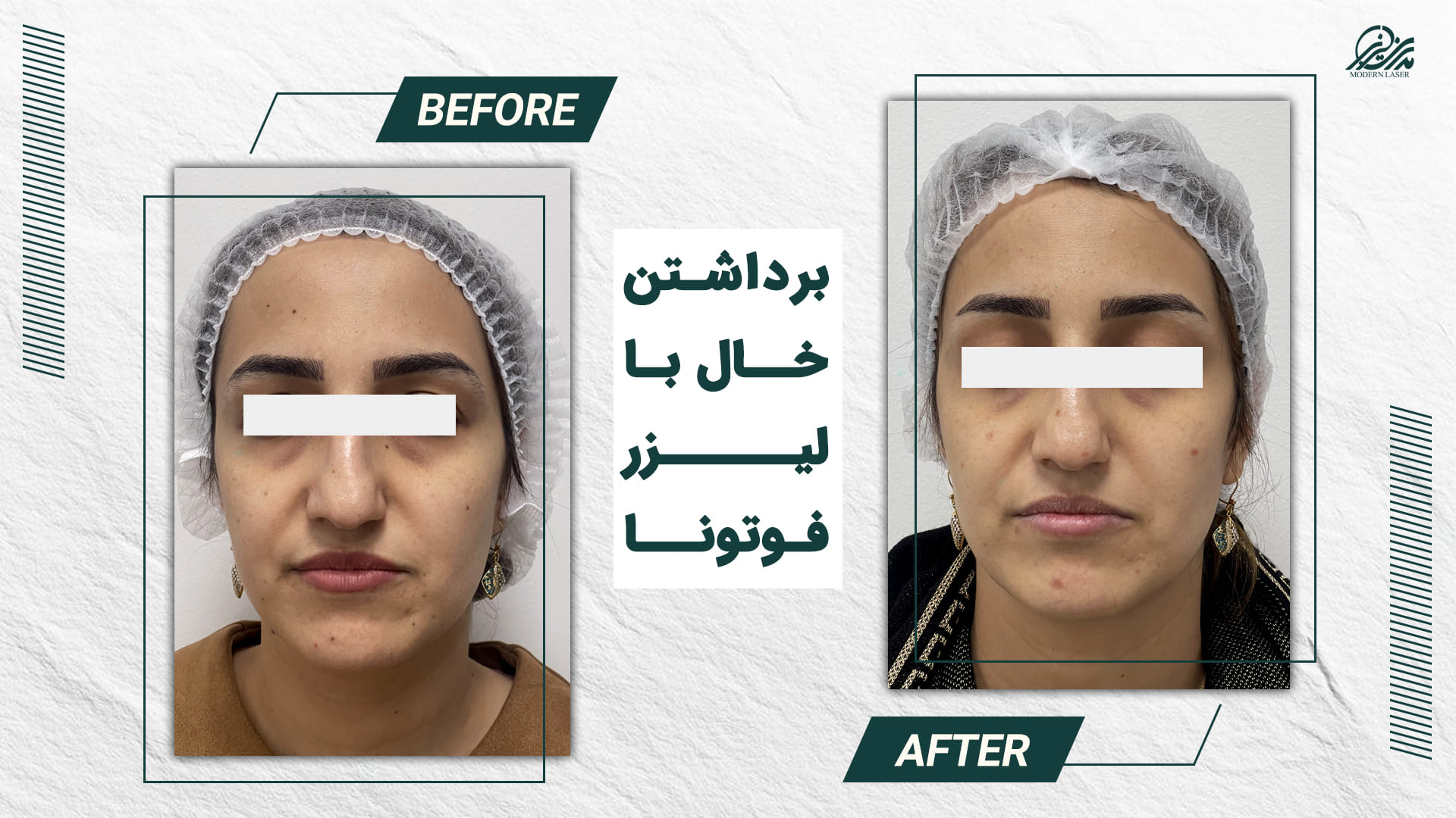 برداشتن خال 4 5