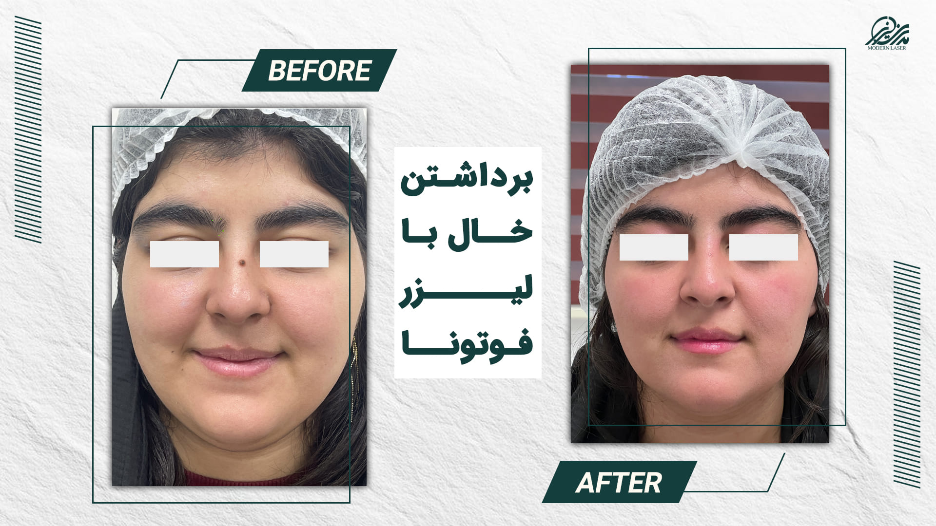 برداشتن خال 5 8