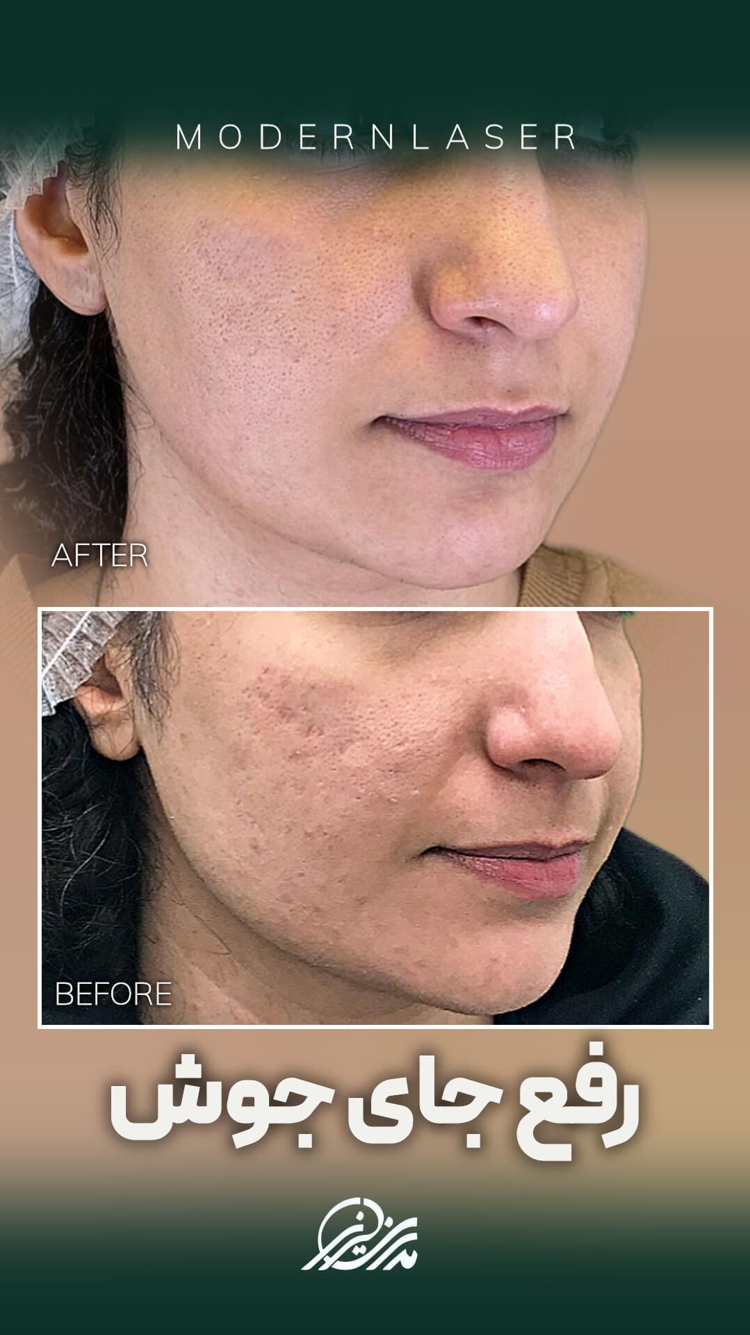 درمان جای جوش در اصفهان 3 جای جوش