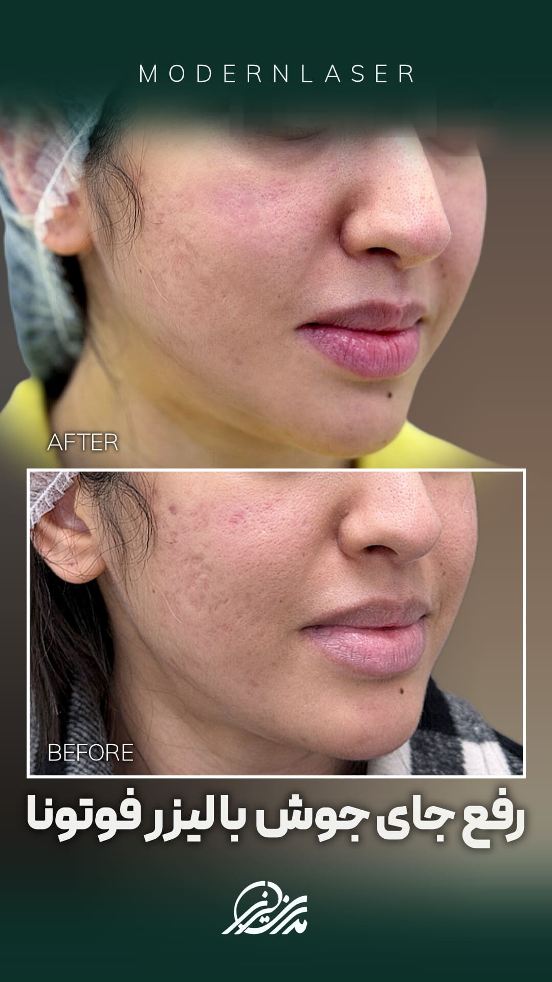 درمان جای جوش در اصفهان 4 جای جوش1