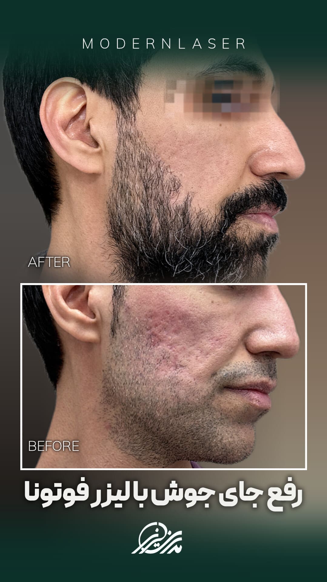 درمان جای جوش در اصفهان 5 جای جوش2