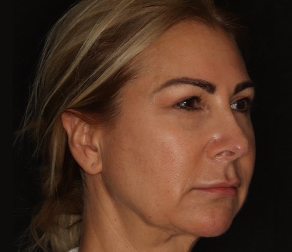 بلفاروپلاستی در اصفهان 2 b111