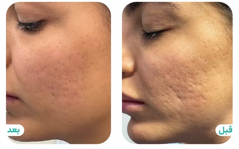 تفاوت آر اف فرکشنال با CO2 | مقایسه کامل RF فرکشنال و لیزر CO2 1 آشنایی کلی با آر اف فرکشنال و CO2