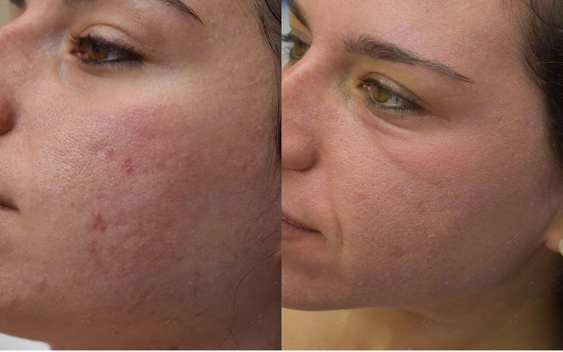 تفاوت آر اف فرکشنال با CO2 | مقایسه کامل RF فرکشنال و لیزر CO2 2 تفاوت آر اف فرکشنال با CO2 از نظر نوع انرژی