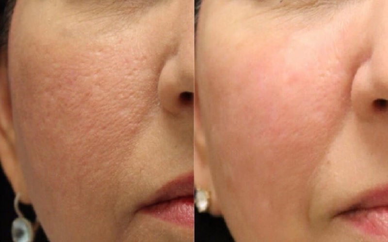 تفاوت آر اف فرکشنال با CO2 | مقایسه کامل RF فرکشنال و لیزر CO2 3 تفاوت آر اف فرکشنال با CO2 از نظر میزان تهاجم