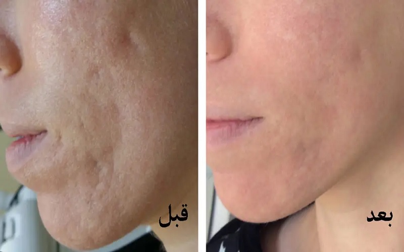 تاثیر لیزر فراکشنال بر جای جوش | راهکاری پیشرفته برای درمان اسکار و جوانسازی پوست 2 بببببب