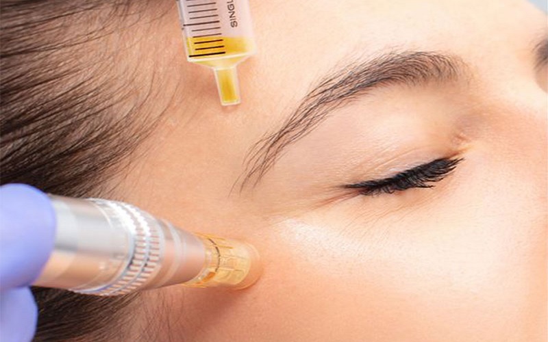 مقایسه میکرونیدلینگ و مزونیدلینگ: کاربردها، مزایا و معایب 2 مزونیدلینگ چیست؟