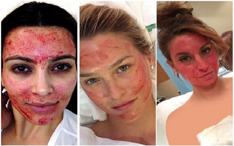 مقایسه میکرونیدلینگ و مزوتراپی: کاربردها، مزایا و معایب 1 میکرونیدلینگ چیست؟