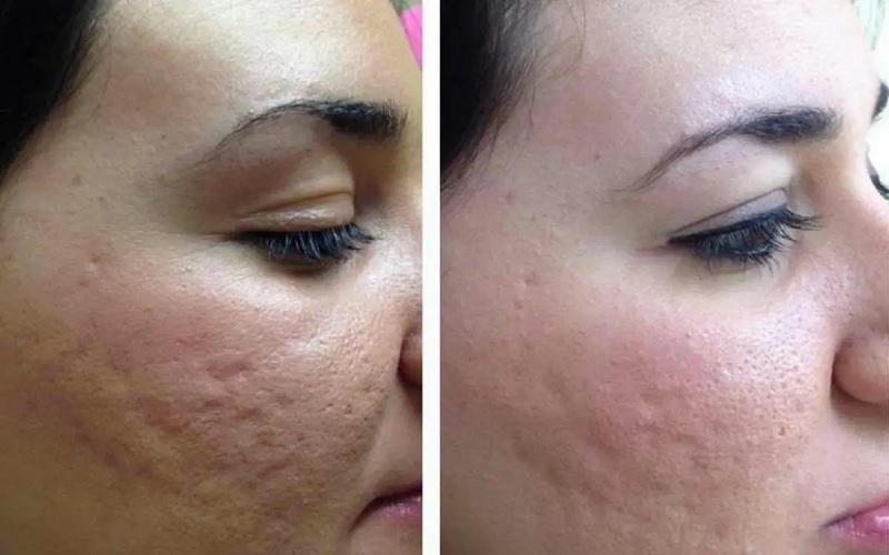 مقایسه میکرونیدلینگ و مزوتراپی: کاربردها، مزایا و معایب 2 مزوتراپی چیست؟