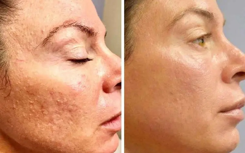 مقایسه میکرونیدلینگ و مزوتراپی: کاربردها، مزایا و معایب 3 مقایسه میکرونیدلینگ و مزوتراپی