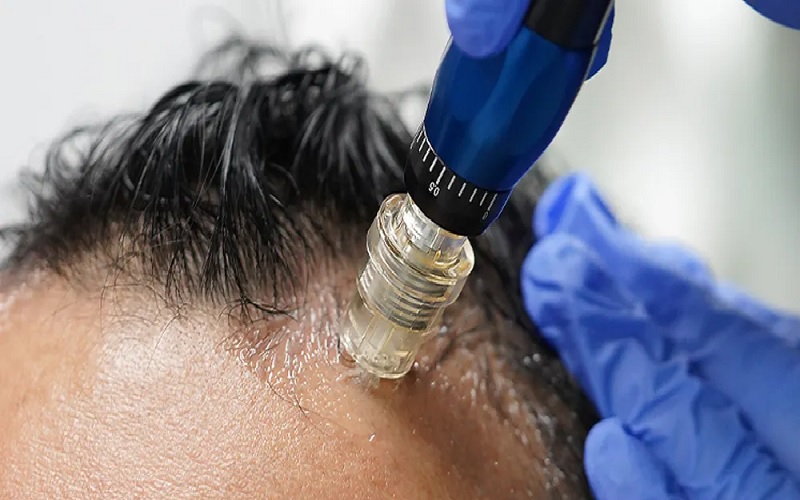 مقایسه مزوتراپی و مزونیدلینگ در درمان ریزش مو: کاربردها، مزایا و معایب 2 مزونیدلینگ برای درمان ریزش مو چیست؟