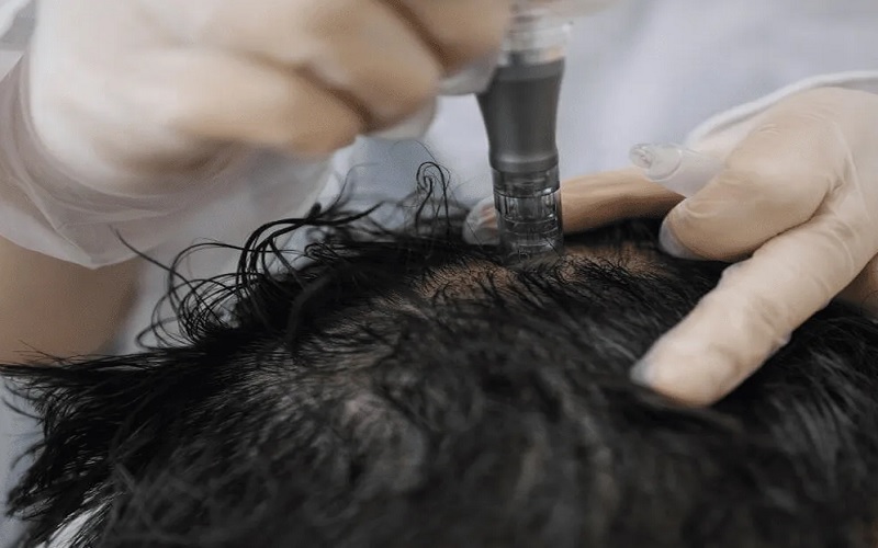 مقایسه مزوتراپی و مزونیدلینگ در درمان ریزش مو: کاربردها، مزایا و معایب 3 مقایسه مزوتراپی و مزونیدلینگ در درمان ریزش مو: معایب