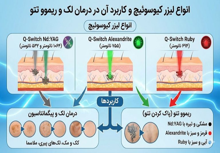 انواع لیزر کیوسوئیچ
