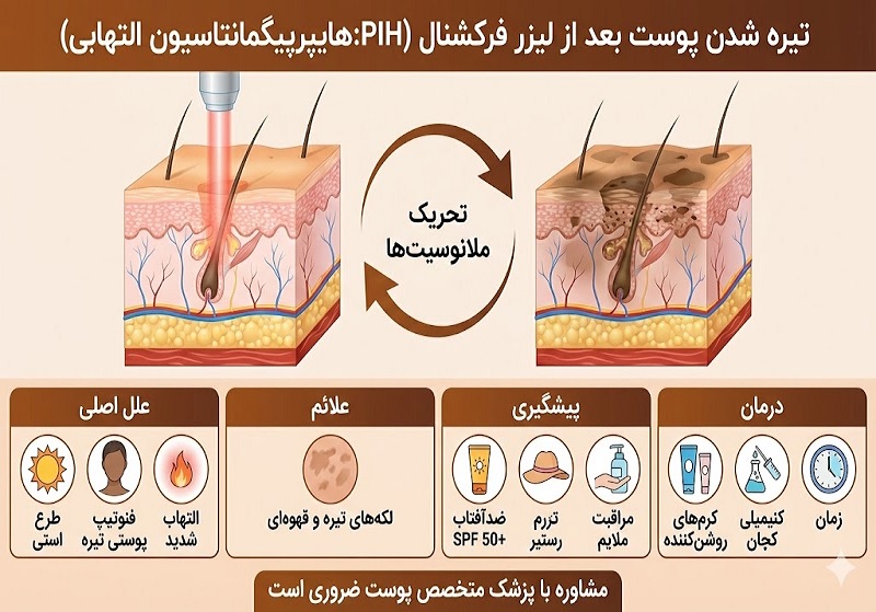 تیره شدن پوست بعد از لیزر فرکشنال