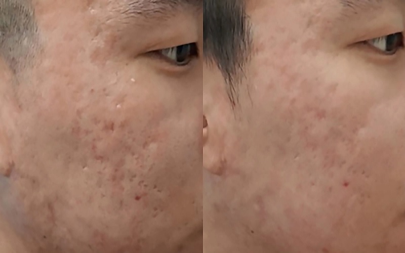 تاثیر لیزر فراکشنال بر جای جوش | راهکاری پیشرفته برای درمان اسکار و جوانسازی پوست 3 انواع جای جوش یا اسکار آکنه