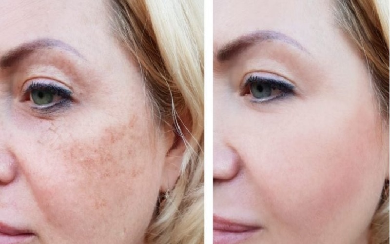 تفاوت لیزر فراکسل و فرکشنال | راهنمای جامع انتخاب بهترین روش درمانی پوست 1 لیزر فراکسل چیست؟