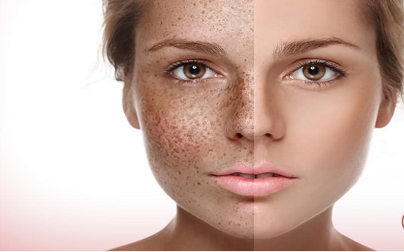 تفاوت لیزر فوتونا با فرکشنال | راهنمای جامع و تخصصی انتخاب بهترین روش درمان پوست 1 معرفی کامل لیزر فوتونا