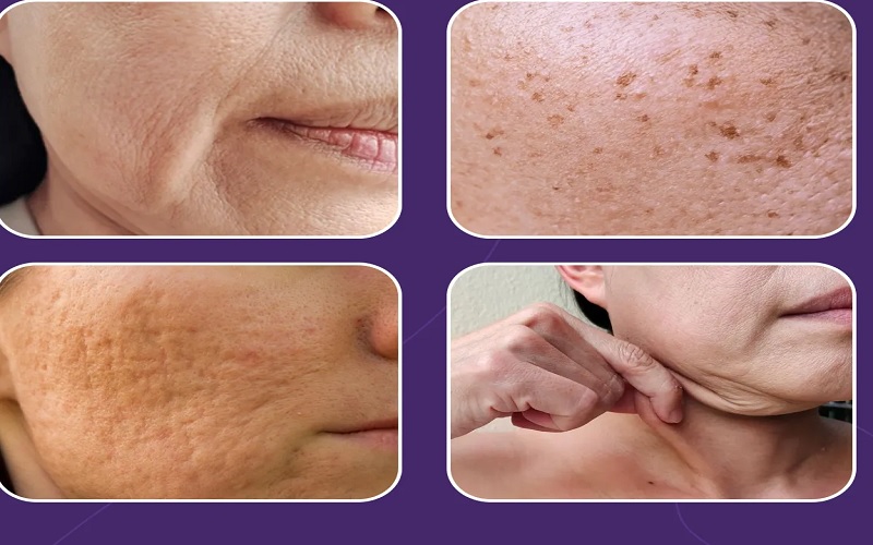 تفاوت لیزر فوتونا با فرکشنال | راهنمای جامع و تخصصی انتخاب بهترین روش درمان پوست 2 تفاوت لیزر فوتونا با فرکشنال از نظر میزان تهاجم و دوران نقاهت