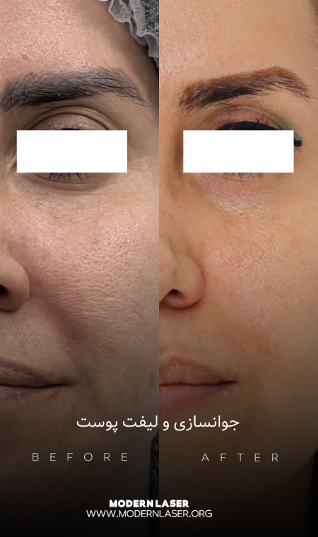 جوانسازی پوست در اصفهان 5 image_2024-07-25_13-23-33