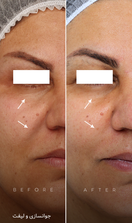 جوانسازی پوست در اصفهان 6 image_2024-08-10_14-21-19